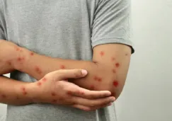 Sarampión en México: Reportan aumento de casos en diciembre ¿Cuáles son los síntomas? Sarampión en México: Reportan aumento de casos en diciembre ¿Cuáles son los síntomas?