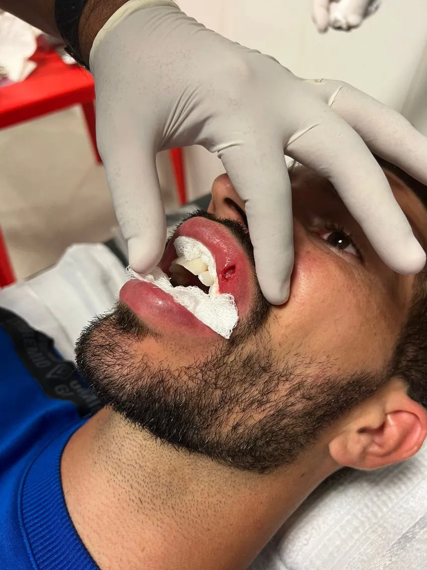 TWITTER: @16LucasSilva Lucas Silva recibió tres puntadas tras agresión con un celular