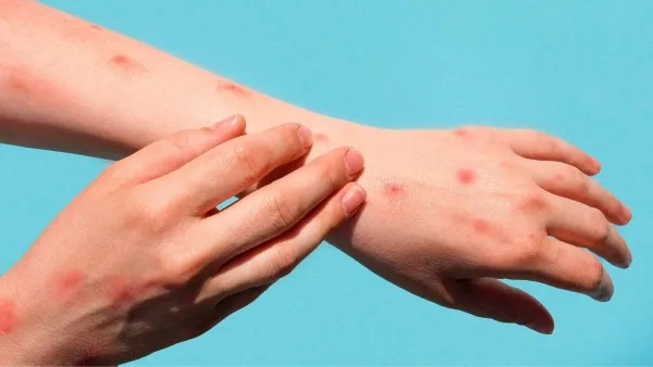 ESPECIAL Se confirma segundo caso de viruela del mono en CDMX