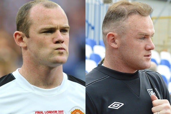 Rooney Se Sometio A Un Segundo Transplante De Cabello