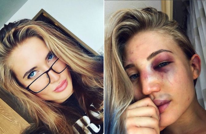 Anastasia Yankova antes y despues de la pelea