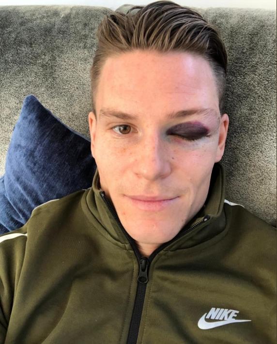 Fotografía de Gameiro con golpe en el ojo 