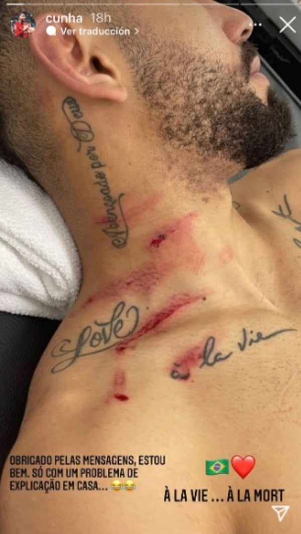 Matheus Cunha exhibió sus heridas en el cuello tras el Brasil vs Ecuador