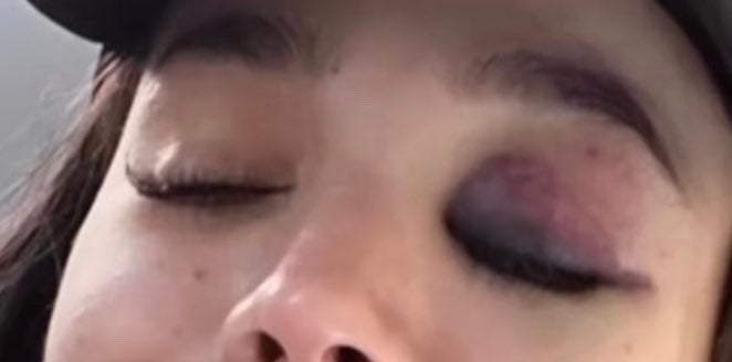 Danna Paola tuvo un accidente que le inflamó el ojo