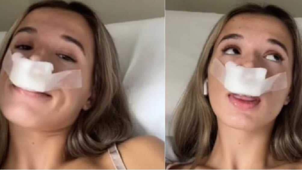 Tiktok de rinoplastia