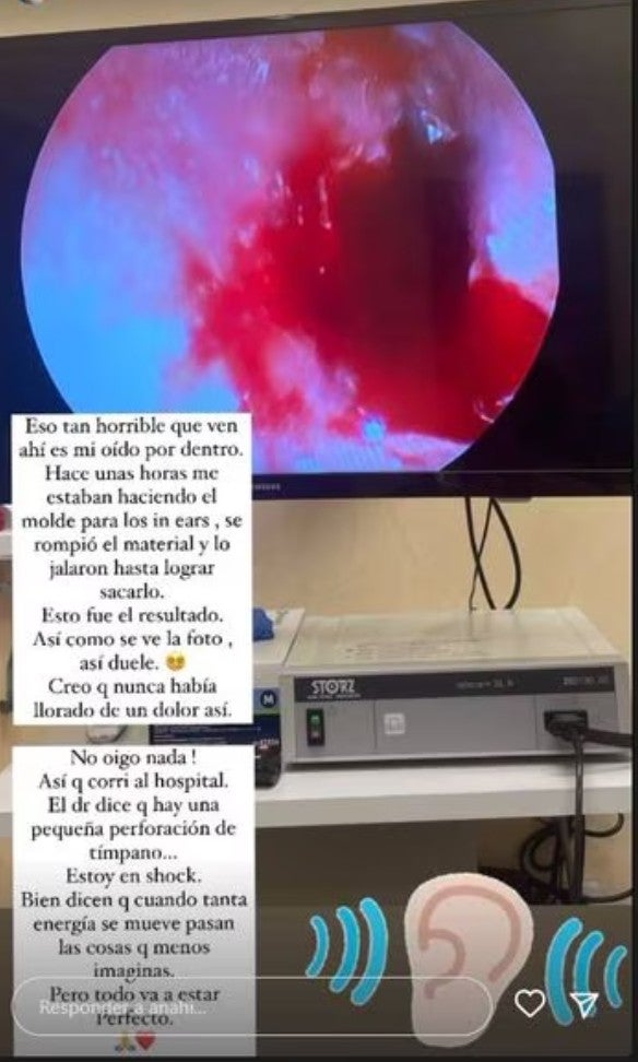 En una segunda historia, mostró los daños que le causó un dispositivo que se rompió dentro de su oído