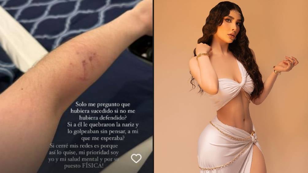 Ivette Camacho, novia de Luis R. Conriquez, también mostró los golpes que recibió. 