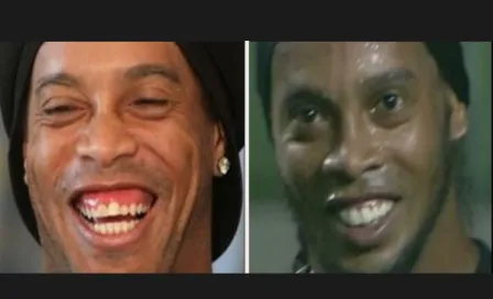 Así quedó Ronaldinho tras cirugía estética dental