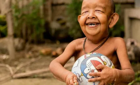 Niño padece enfermedad que lo hace ver como anciano