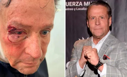 Alfredo Adame, brutalmente golpeado y con posible desprendimiento de retina